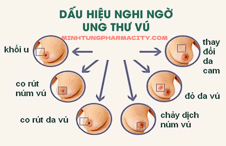 Ung thư vú : Nguyên nhân, triệu chứng và phương pháp điều trị - Nhà Thuốc Minh Tùng Pharmacity